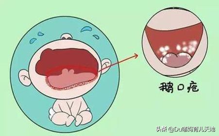 鹅口疮能自愈吗鹅口疮怎么治,什么是鹅口疮啊