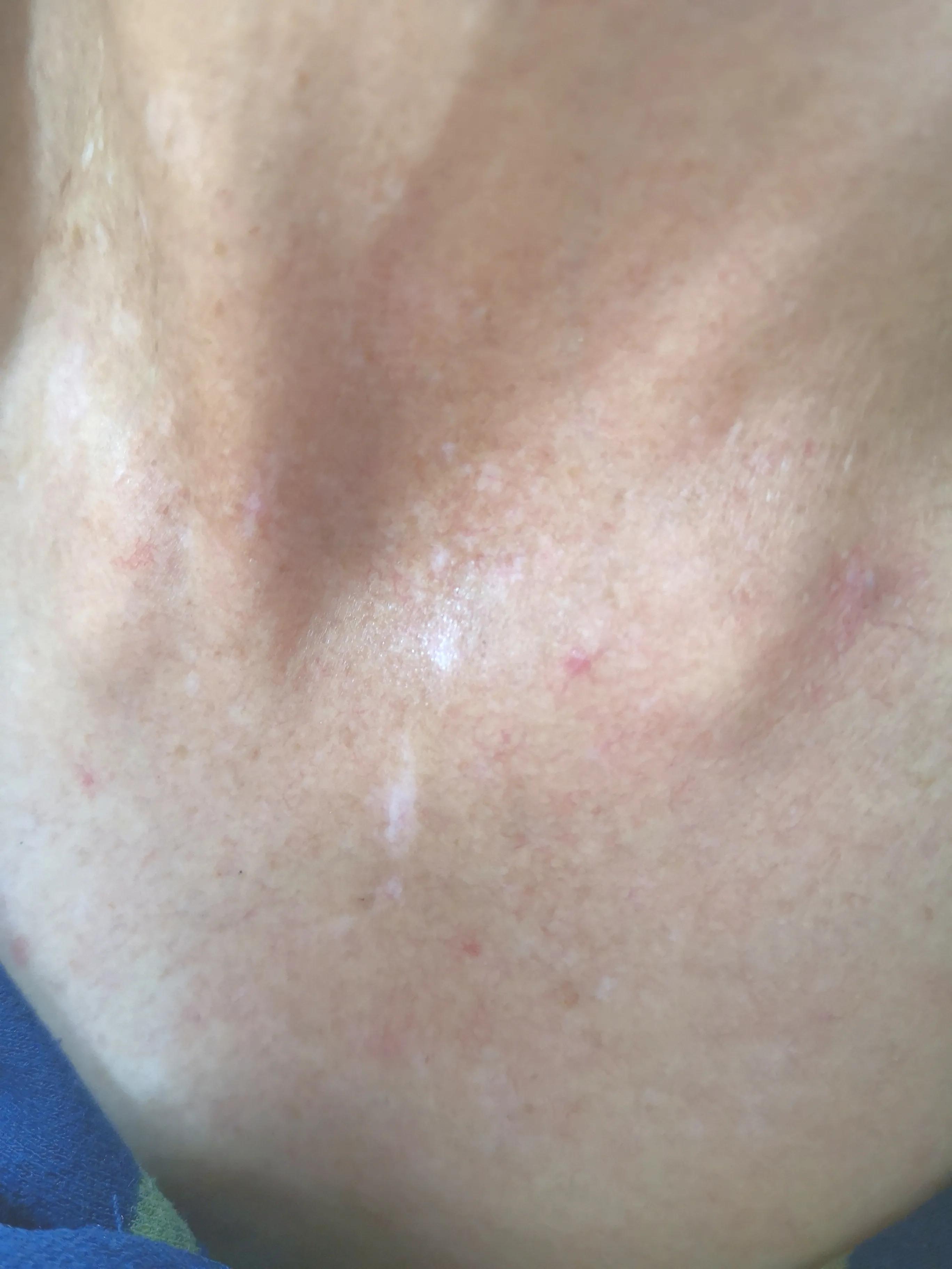 身上长了白癜风怎么办,身上长白癜风是怎么引起的