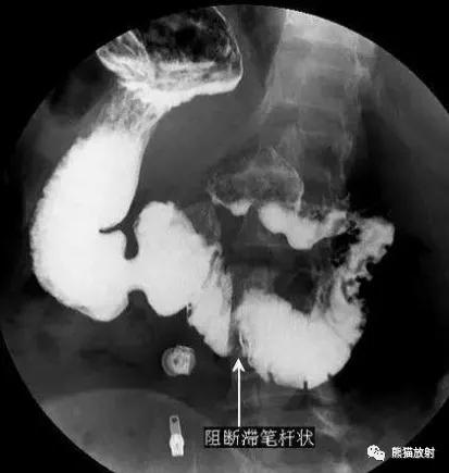 十二指肠球部溃疡解剖位置,十二指肠球部溃疡x线表现
