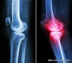 骨刺吃什么药可以抑制骨刺的生长,长骨刺独家药方喝四天就能止痛