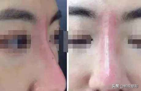 六种常见的失败隆鼻手术,隆鼻怎么预防鼻头越来越尖