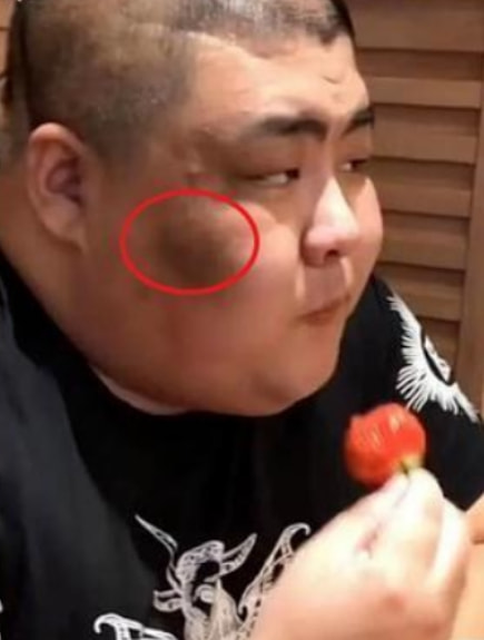 恩克脸上的黑斑,恩克面部频繁出现黑斑