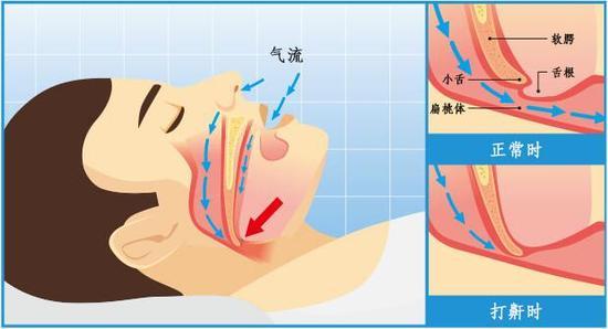 打鼾睡得香严重打鼾可致命,打鼾是睡得香吗