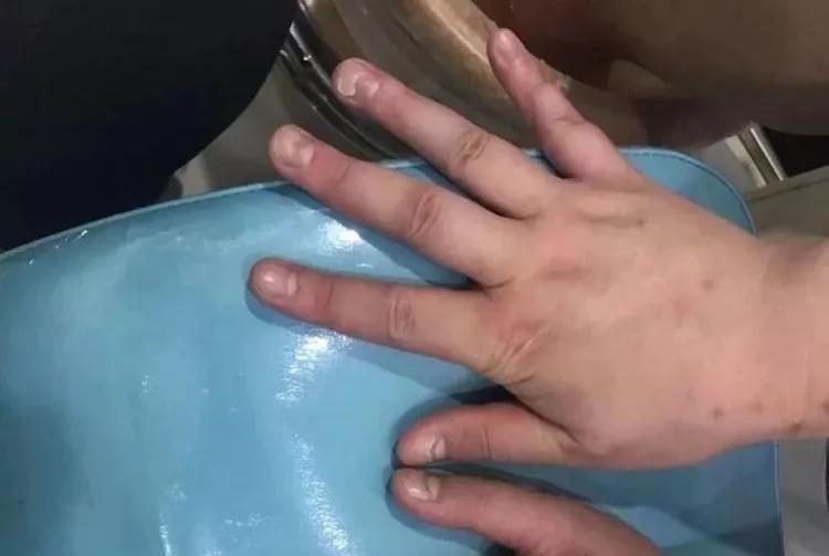 指甲月牙白少说明了什么,指甲月牙白内凹陷是病吗