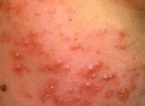 长痘痘的症状有哪些呢,长痘痘的原因及解决方法