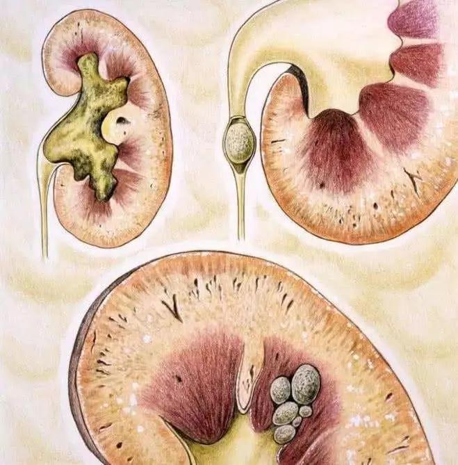 预防结石产生，从一杯碱性好水开始