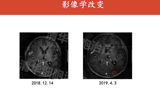 肺癌晚期活不了多久的症状,肺癌晚期生命只剩下六个月