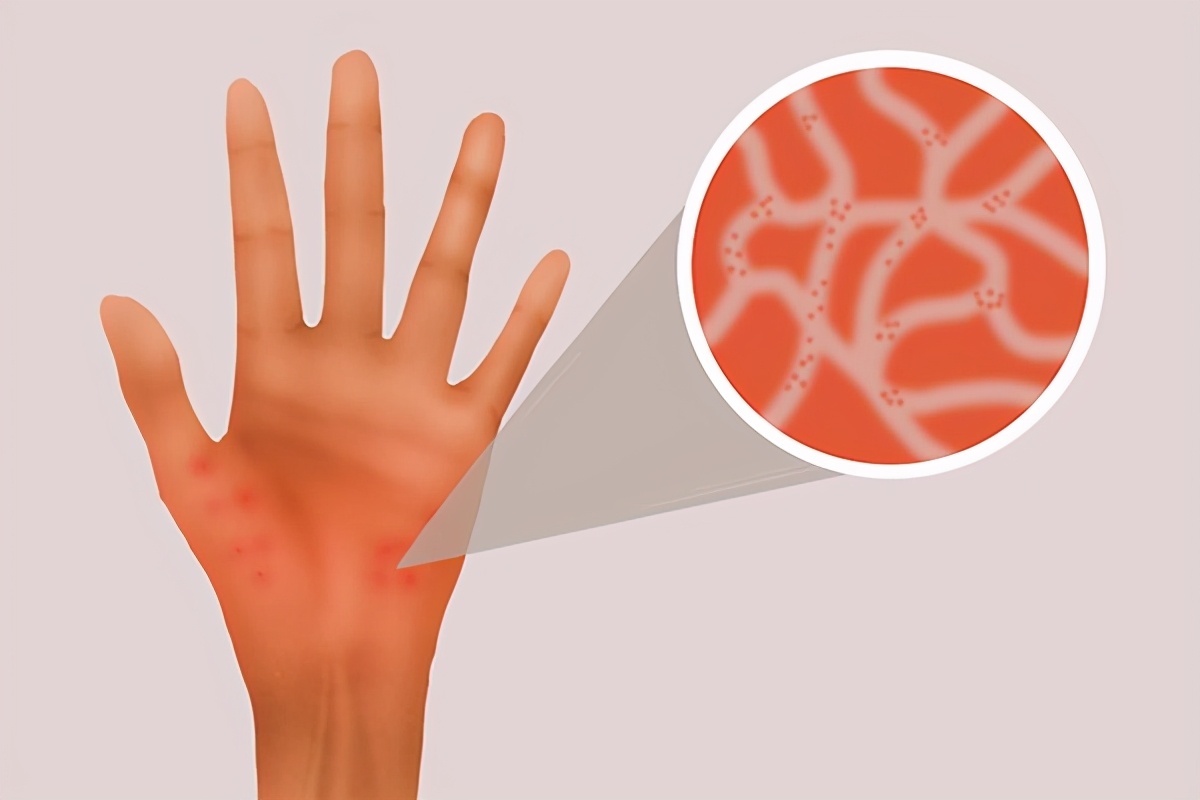 得了麻疹应该吃的菜,有麻疹应该吃点什么