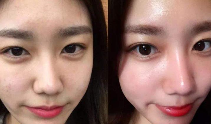 皮肤科脸上长闭口怎么办,皮肤科脸上闭口