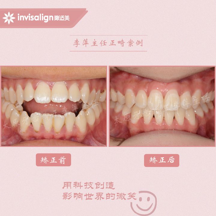 太原矫正牙齿需要做正颌吗,太原牙齿二次矫正