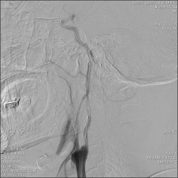 颅内覆膜支架应用于肿瘤侵袭性颈内动脉治疗