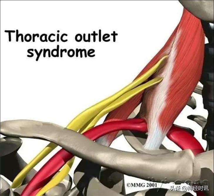 周围神经卡压解剖与分析,腓浅神经卡压解剖视频