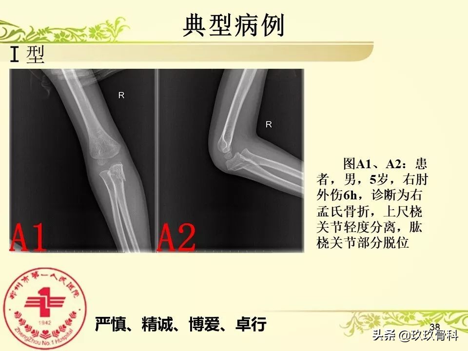 孟氏骨折功能训练多久能恢复正常,孟氏骨折中医能治吗