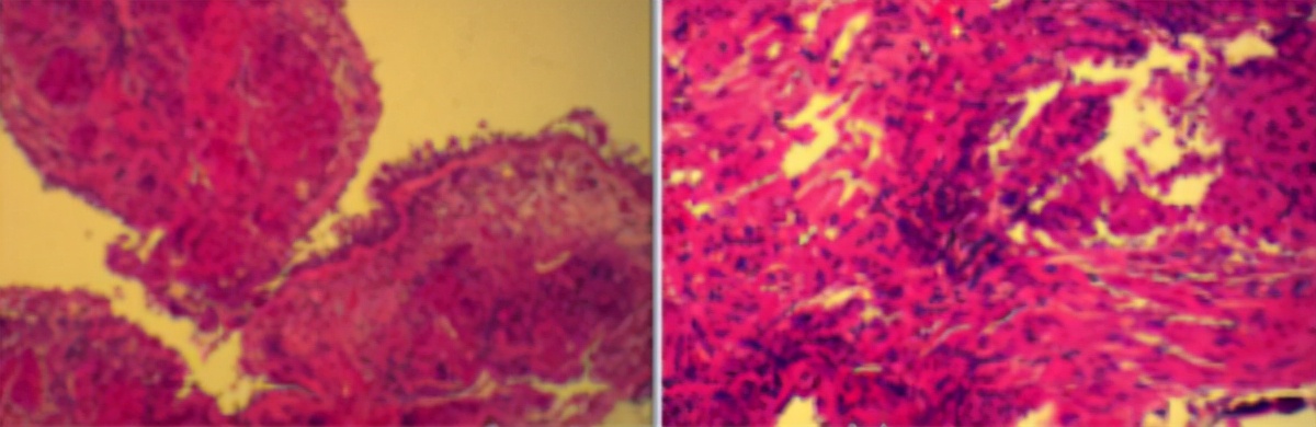 鍖荤敓鏃犳硶鍒ゆ柇缁撹妭鐥呰繕鏄粨鏍哥梾,鏈夎偤缁撴牳鐥呭彶鍗佸嚑骞存煡鍑鸿偤缁撹妭