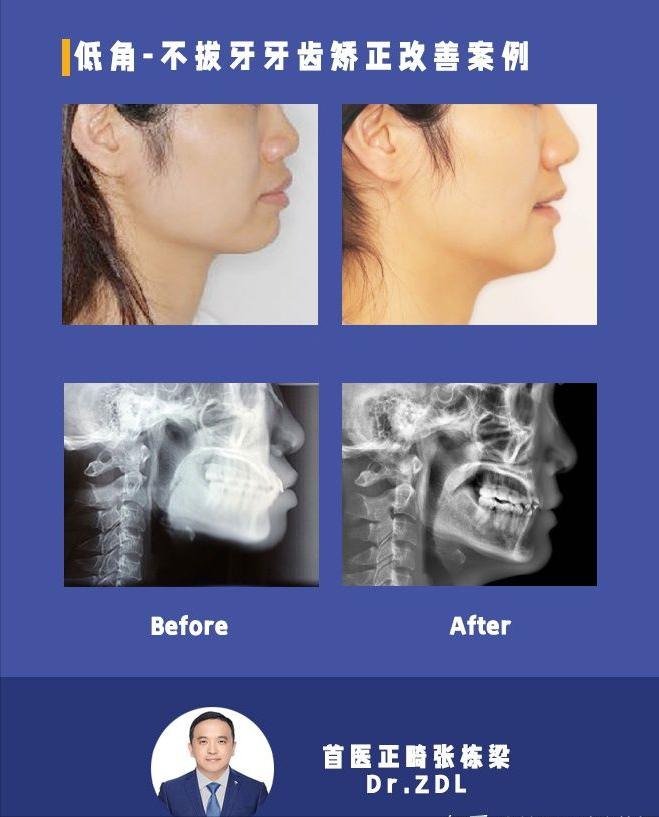 戴牙套矫正牙齿脸型会变好看吗,隐形牙套矫正后脸型变化