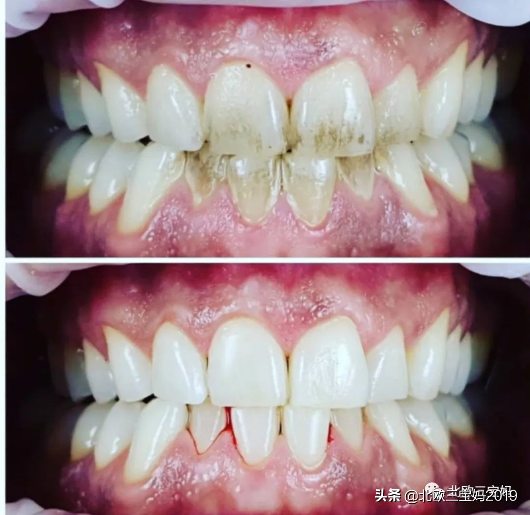 3岁儿童全麻做根管有影响吗,宝宝捆绑治疗蛀牙