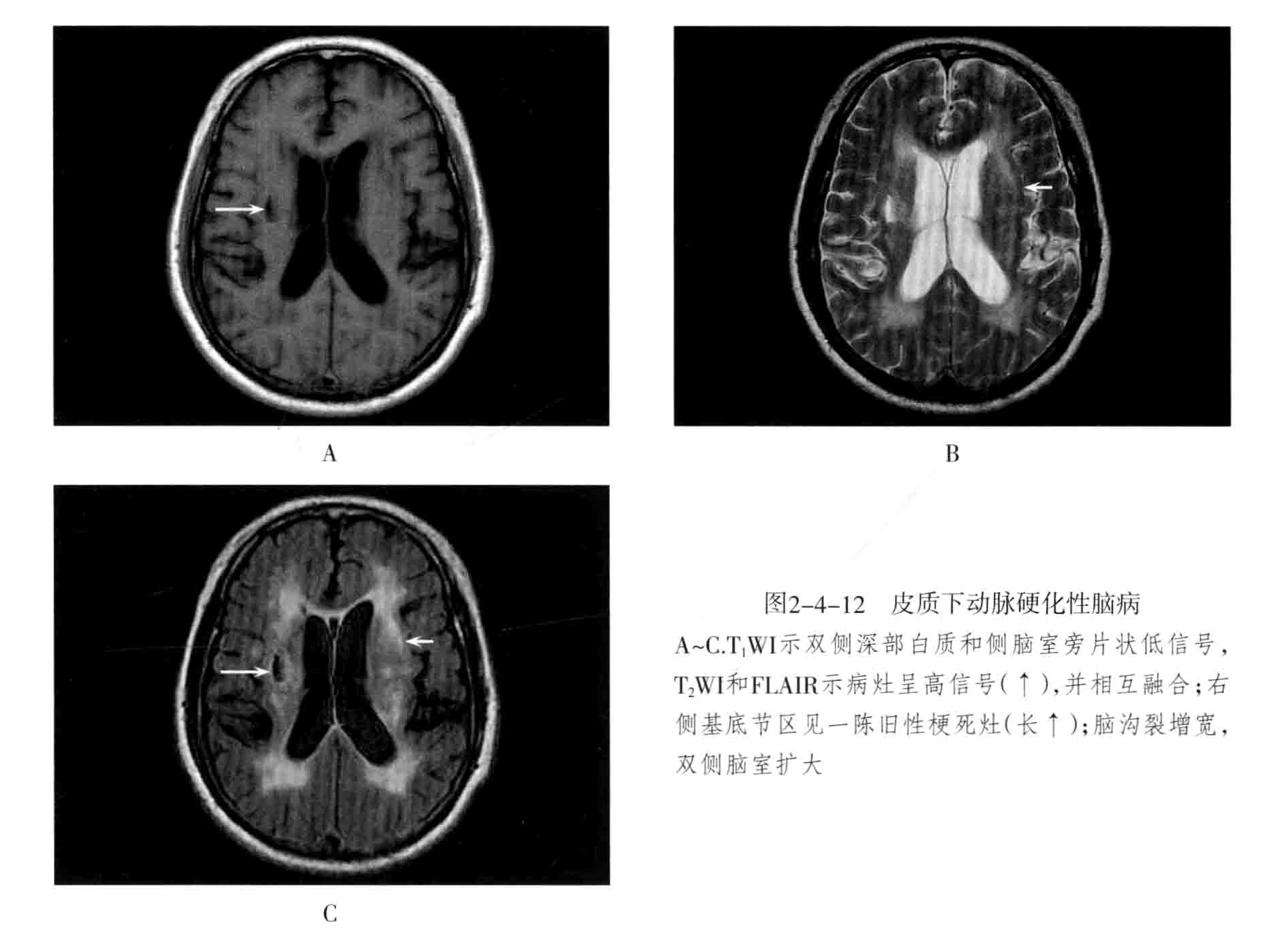 颅内血管周围间隙的影像鉴别,颅脑血管源性疾病影像诊断