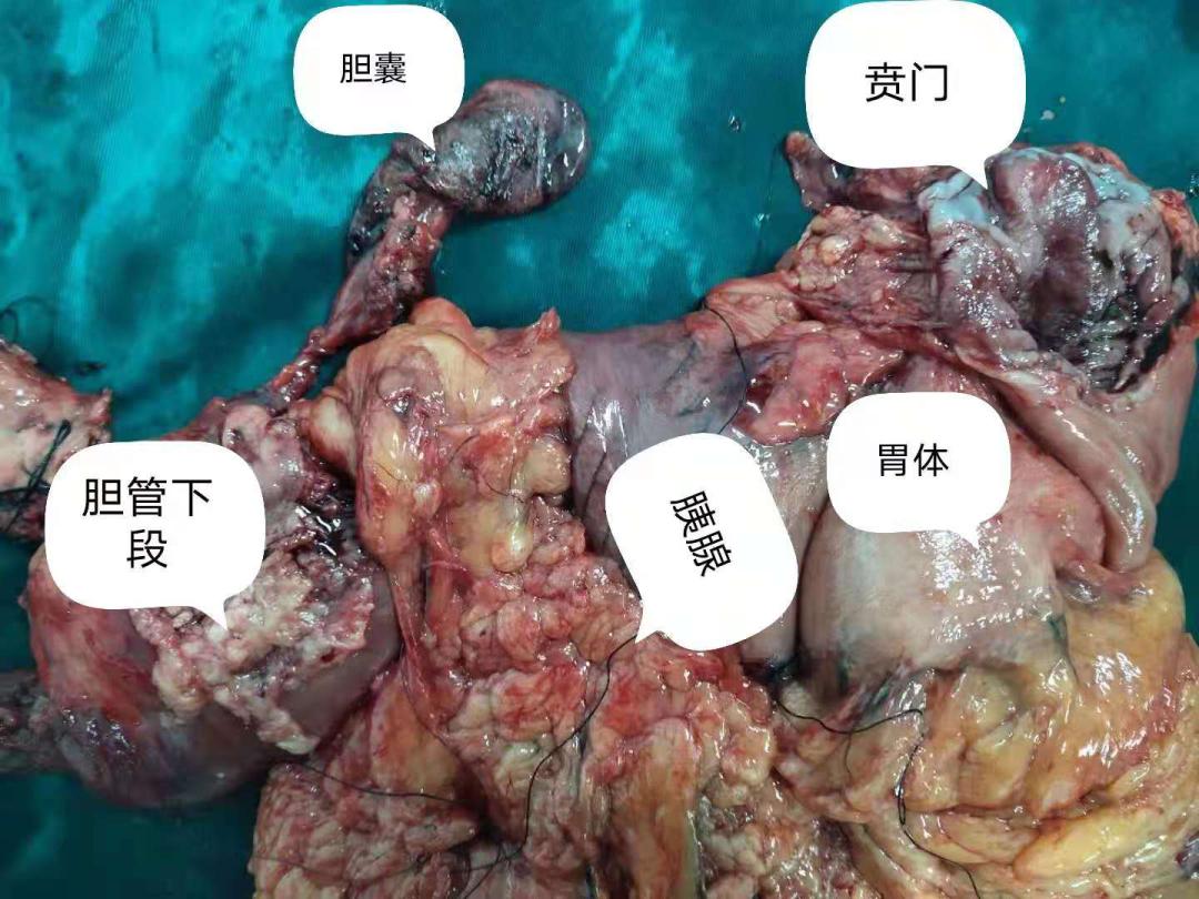 我院肝胆外科主任许其威、副主任医师兰军良团队完成一例保脾全胰十二指肠联合全胃根治性切除治疗多原发癌