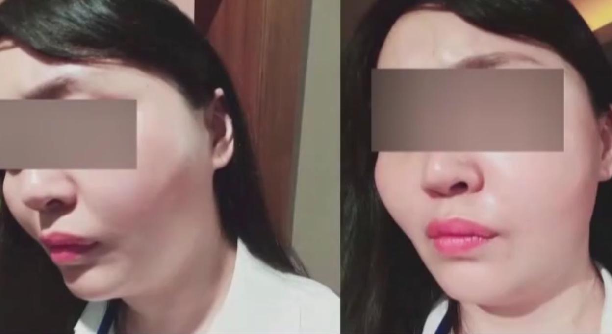 女子注射美容针后续,女子花数万元打美白针