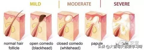 博乐达水杨酸面膜真实测评,博乐达水杨酸面膜祛痘效果怎么样