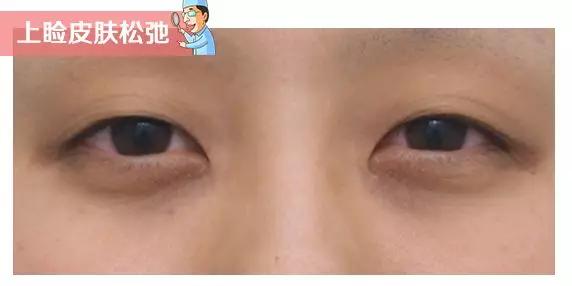 黑眼圈泪沟法令纹怎么遮,黑眼圈泪沟法令纹很重怎么办