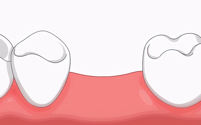 即刻种植即刻修复免受缺牙的困扰,种植牙缺牙患者的最佳选择医院