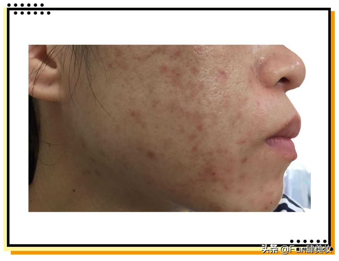 痘印痘坑真正祛除的方法,痘印痘坑去不掉怎么办