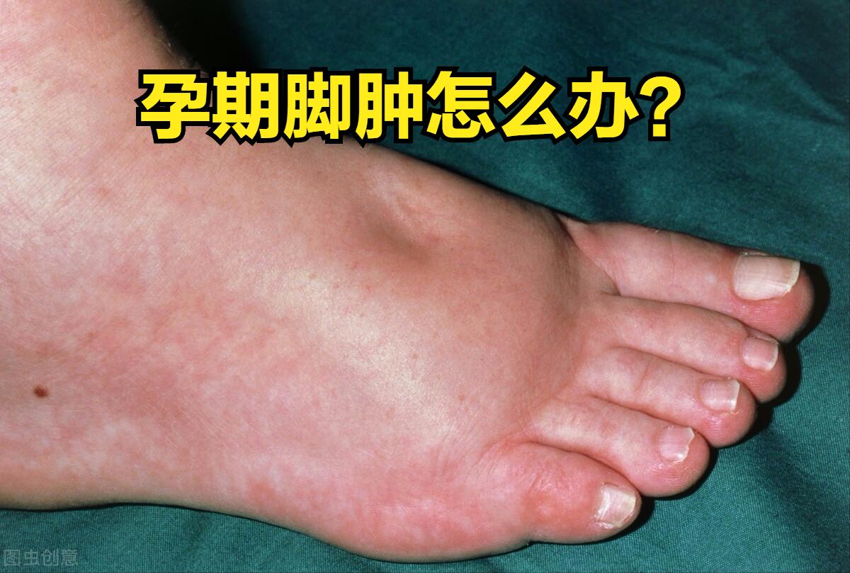 孕妇孕后期脚肿了怎么快速消肿,孕期脚肿解决方法用盐水泡