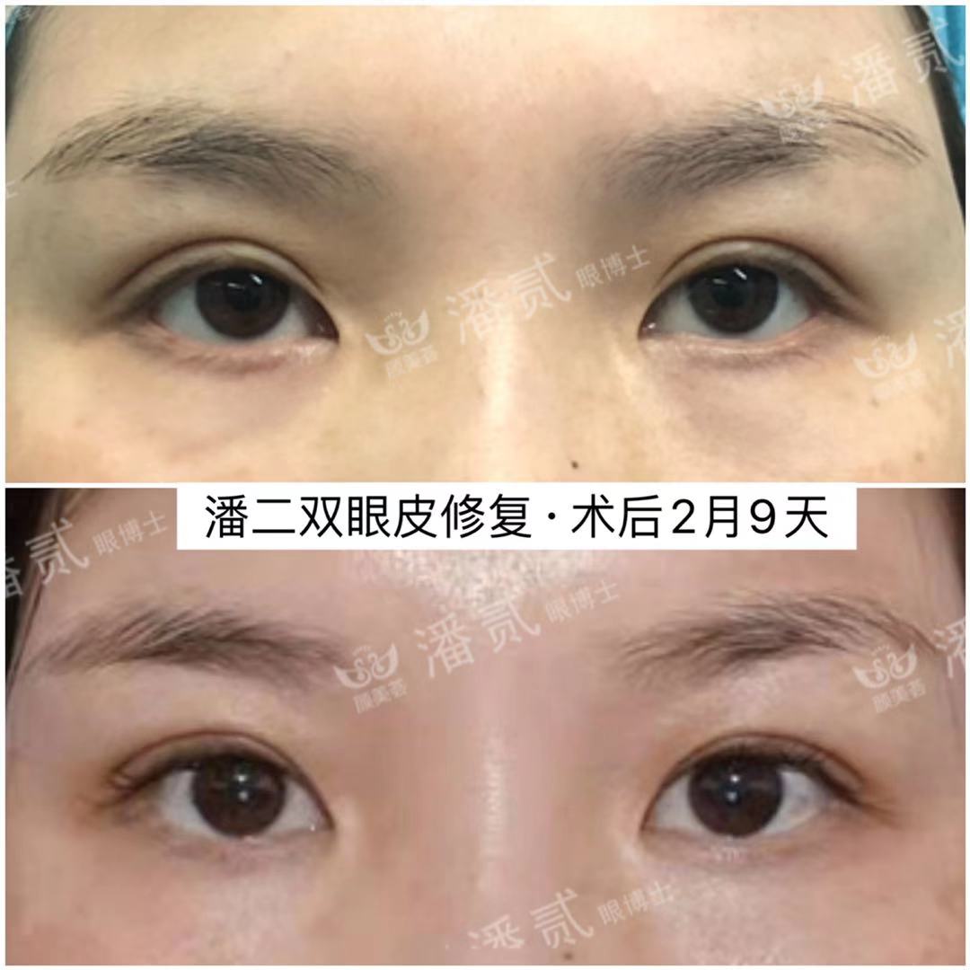做过韩式三点双眼皮还能重新做吗,韩式三点双眼皮5年后修复
