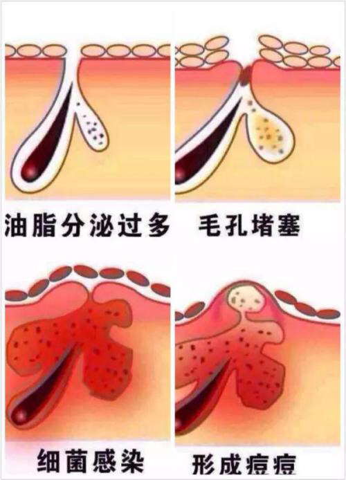 暗疮囊肿为什么要消炎,起脓疮型痘痘用什么药