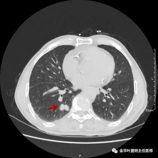 多发原发肺癌能根治吗,肺部原发性恶性肿瘤好治