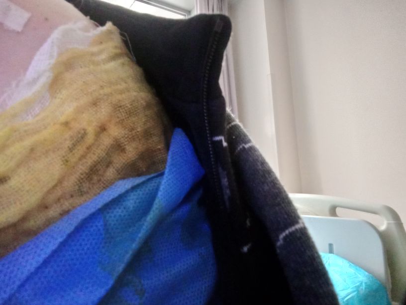 山西治水肿的中医,水肿住院调养