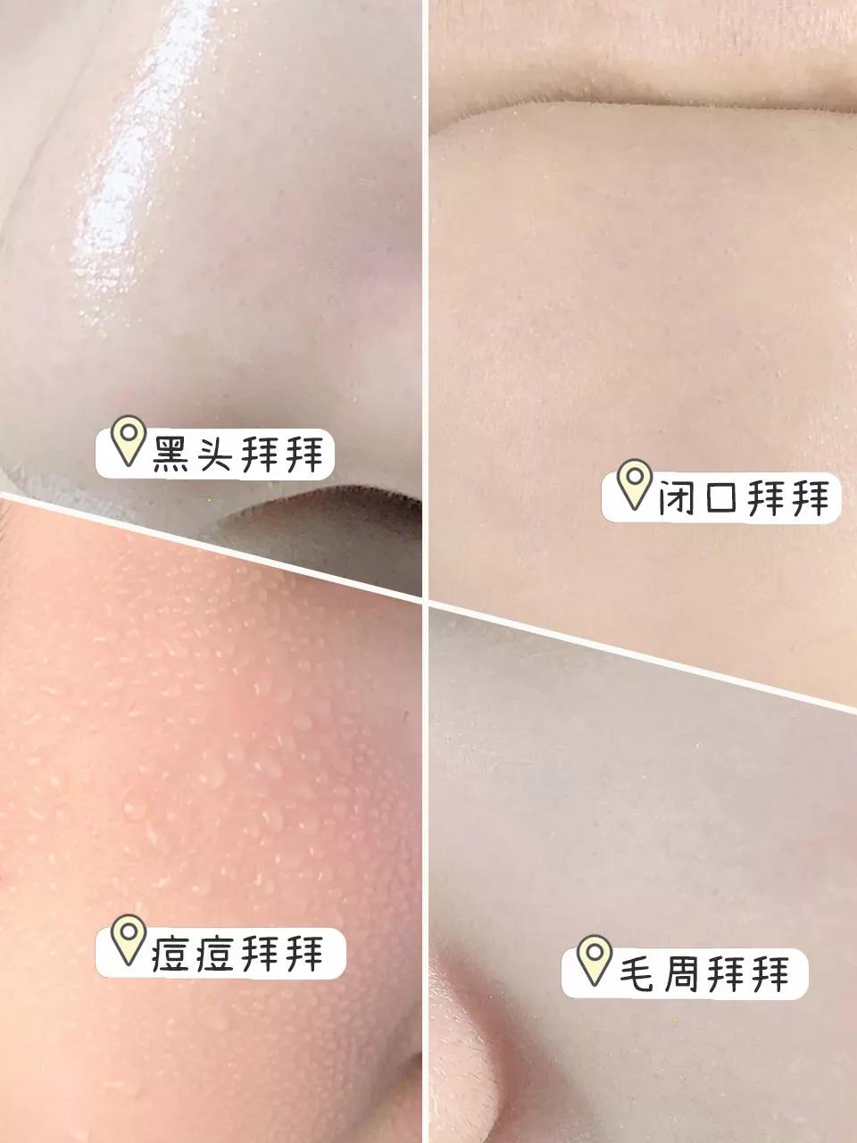 生理盐水把痘消了,去痘痘黑头和痘印