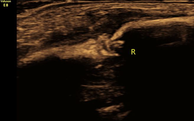 八个月大宝宝锁骨断了,新生儿锁骨断了错位