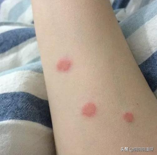 如何判断自己得了猫癣,如何判断猫得了猫癣