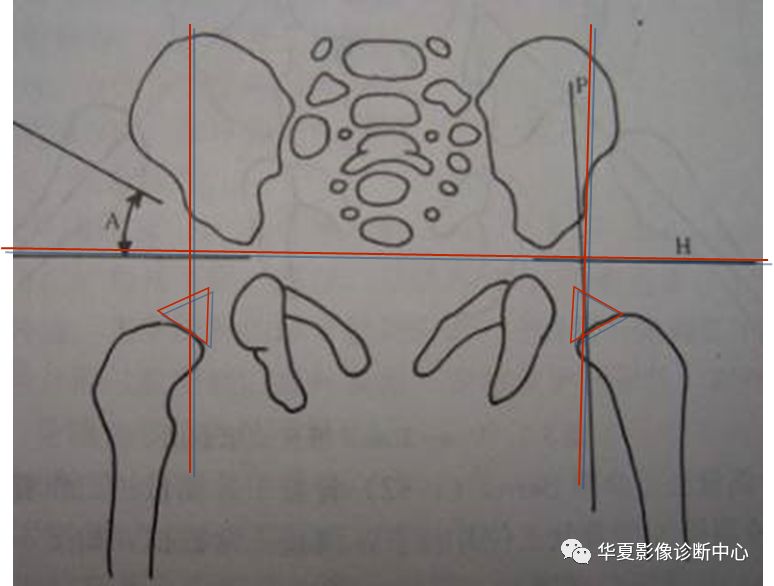 先天性髋关节脱位截骨术全过程,先天性髋关节脱位可以考驾驶证吗