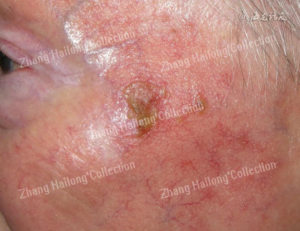 阿达帕林能治痤疮吗,托法替布在皮肤科的应用