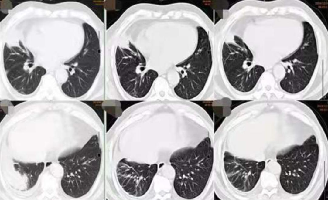 56岁男性发现双肺数百个结节,肺部肿块伴胸腔积液