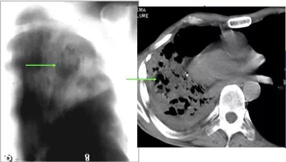 肺部ct十大征象,肺部ct正常图和异常图的区别
