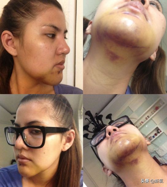 18岁土肥圆豪掷800万全身整形，鼻子6次大整假体穿出，效果却超美