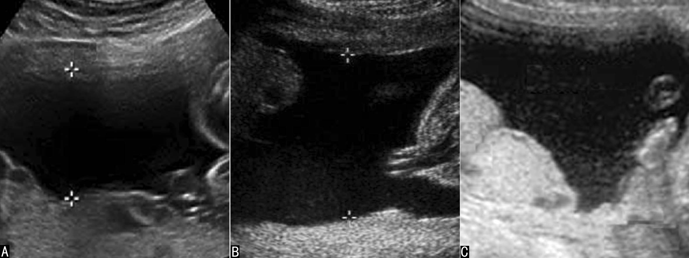 明明白白做超声(十九):羊水和胎膜超声检查