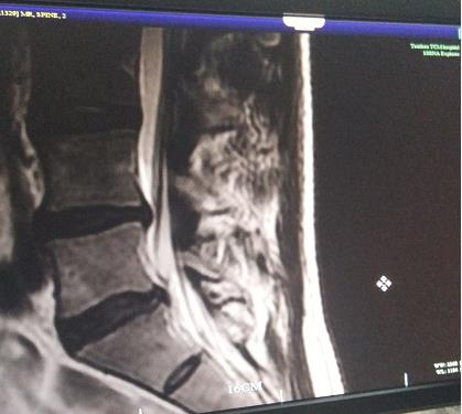 腰椎间盘突出卧床休息几周能康复,腰椎间盘突出4-5压迫神经康复训练