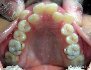 孩子出现双排牙要注意什么,1周岁双排牙怎么处理