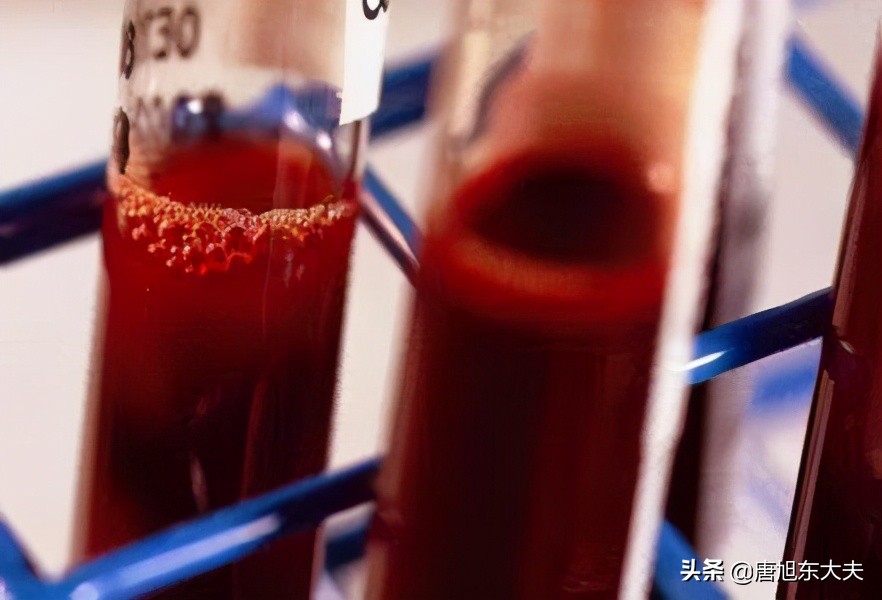 儿童免疫性血小板减少症怎么调理,儿童免疫性血小板低怎么治愈