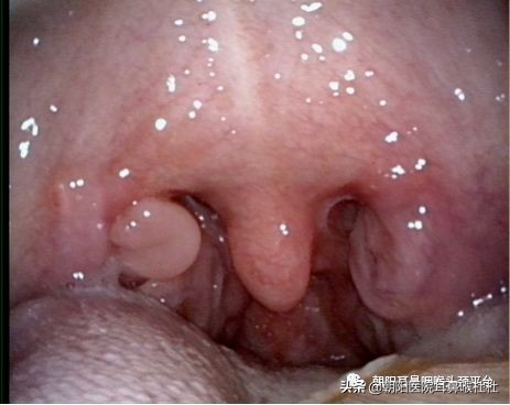 扁桃体腺样体切除后什么时间最痛,扁桃体切除后白膜脱落时更痛了