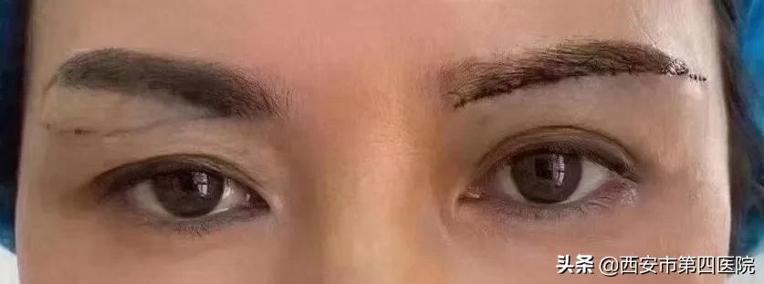 提眉术后注意事项及禁忌,提眉术能改善哪些问题