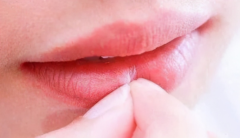 唇炎干裂脱皮怎么治,唇部干裂唇炎图片