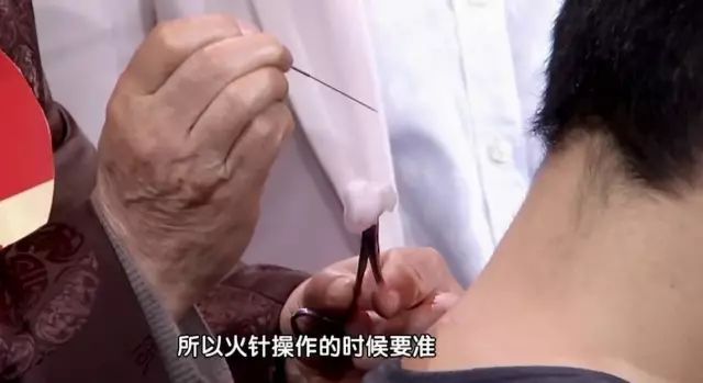 针灸名医治脾胃,各种病的针灸特效穴