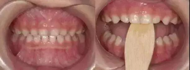 地包天早期矫正最佳时间,地包天10-15岁矫正是最佳年龄吗