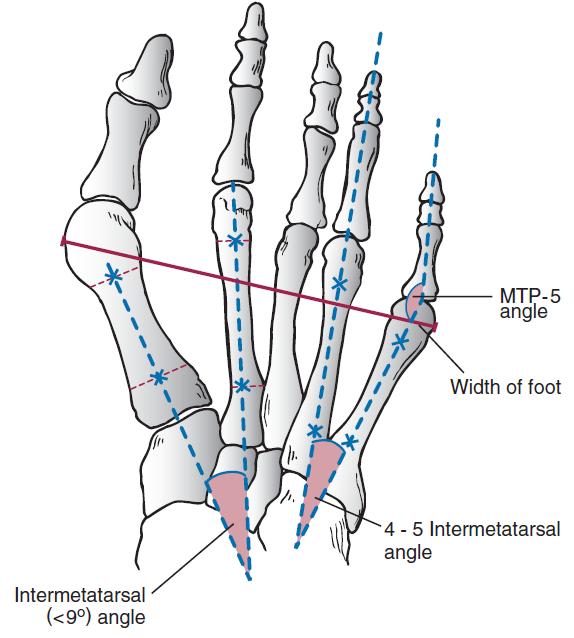 小脚趾滑囊炎警惕四种病,小脚趾拇囊炎怎么治疗